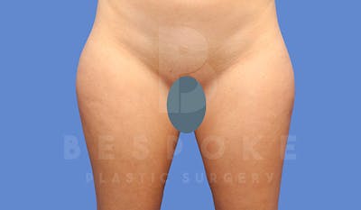 Liposuction Before & After Gallery - Patient 4657493 - Image 1
