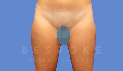 Liposuction Before & After Gallery - Patient 4657493 - Image 2