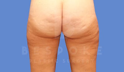 Liposuction Before & After Gallery - Patient 4657493 - Image 4