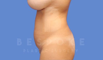Liposuction Before & After Gallery - Patient 4657494 - Image 1