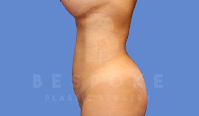 Liposuction Before & After Gallery - Patient 4657494 - Image 2