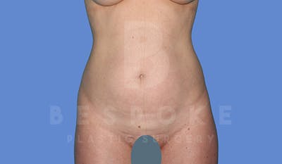 Liposuction Before & After Gallery - Patient 4657495 - Image 1