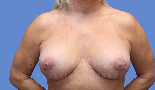 Breast Lift With Implants Before & After Gallery - Patient 4657496 - Image 2