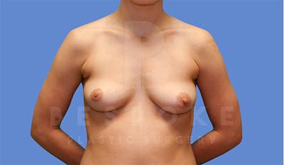 Breast Augmentation Before & After Gallery - Patient 4670730 - Image 1