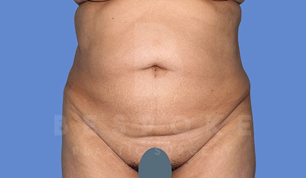 Tummy Tuck Before & After Gallery - Patient 4670971 - Image 1