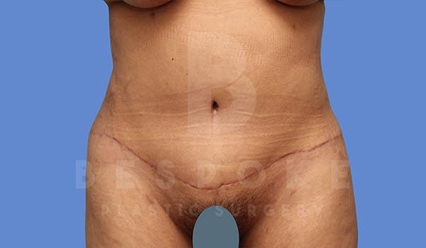 Tummy Tuck Before & After Gallery - Patient 4670971 - Image 2