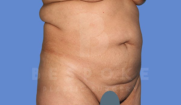 Tummy Tuck Before & After Gallery - Patient 4670971 - Image 3