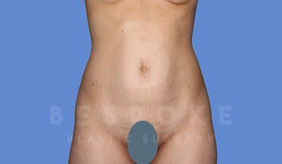 Tummy Tuck Before & After Gallery - Patient 4670972 - Image 1