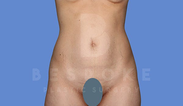 Tummy Tuck Before & After Gallery - Patient 4670972 - Image 1