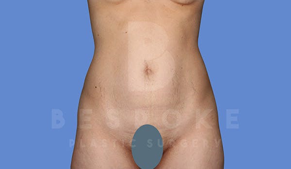 Tummy Tuck Gallery - Patient 4670972 - Image 1