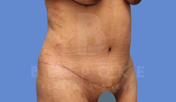 Tummy Tuck Before & After Gallery - Patient 4670971 - Image 4