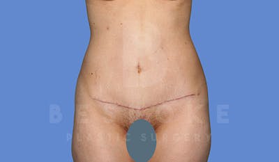 Tummy Tuck Gallery - Patient 4670972 - Image 2