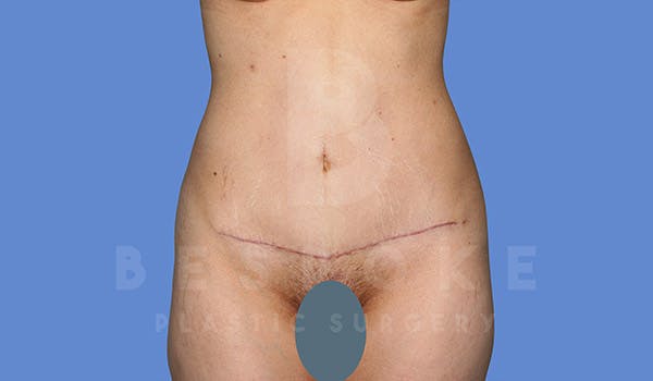 Tummy Tuck Before & After Gallery - Patient 4670972 - Image 2