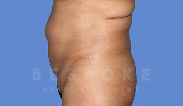 Tummy Tuck Before & After Gallery - Patient 4670971 - Image 5