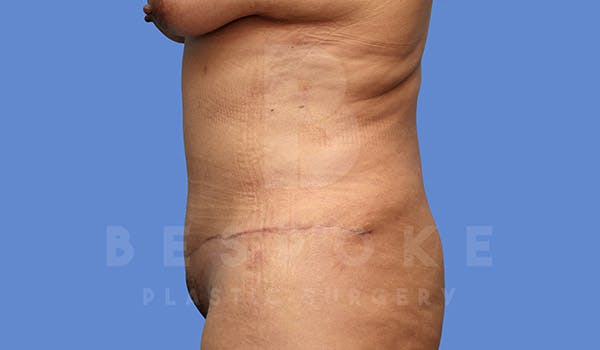 Tummy Tuck Before & After Gallery - Patient 4670971 - Image 6