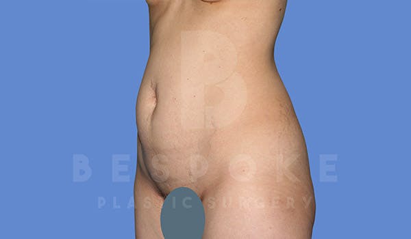 Tummy Tuck Before & After Gallery - Patient 4670972 - Image 5