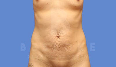 Tummy Tuck Before & After Gallery - Patient 4709955 - Image 1