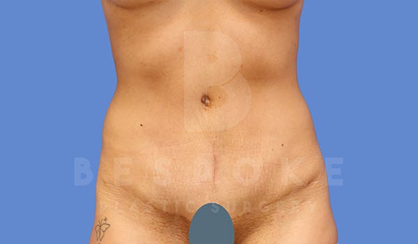 Tummy Tuck Before & After Gallery - Patient 4709955 - Image 2