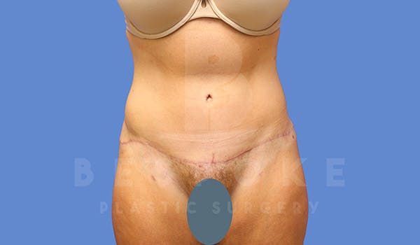 Tummy Tuck Before & After Gallery - Patient 4709956 - Image 2