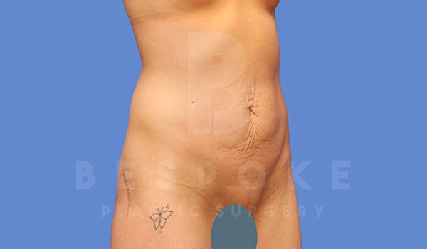 Tummy Tuck Before & After Gallery - Patient 4709955 - Image 3