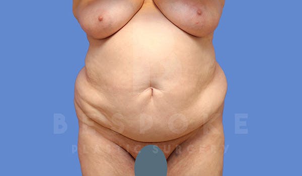 Tummy Tuck Before & After Gallery - Patient 4709957 - Image 1
