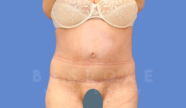 Tummy Tuck Before & After Gallery - Patient 4709957 - Image 2