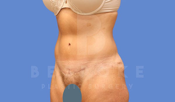 Tummy Tuck Before & After Gallery - Patient 4709956 - Image 4