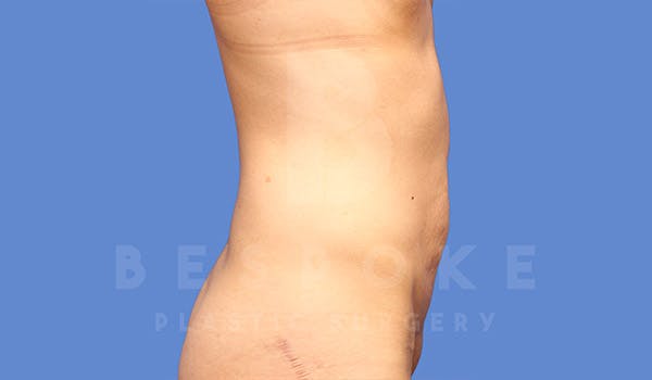 Tummy Tuck Before & After Gallery - Patient 4709955 - Image 5