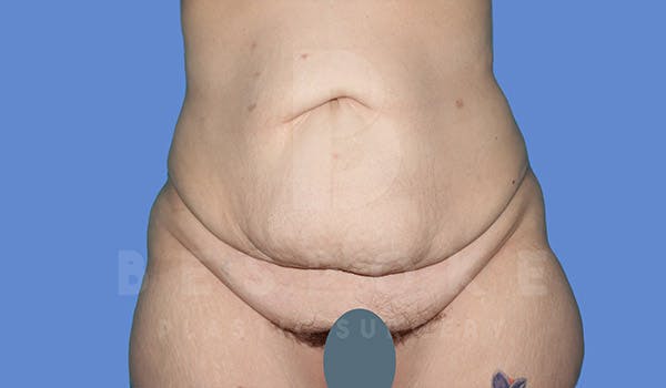 Tummy Tuck Before & After Gallery - Patient 4709958 - Image 1