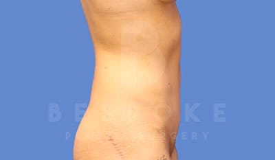 Tummy Tuck Before & After Gallery - Patient 4709955 - Image 6