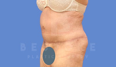 Tummy Tuck Before & After Gallery - Patient 4709957 - Image 4