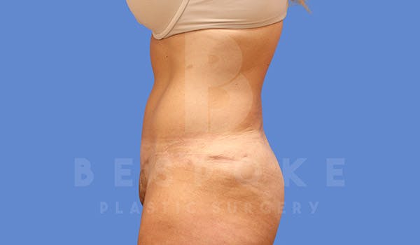 Tummy Tuck Gallery - Patient 4709956 - Image 6