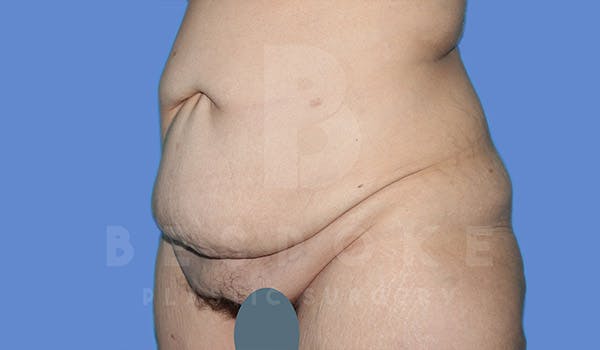 Tummy Tuck Before & After Gallery - Patient 4709958 - Image 3