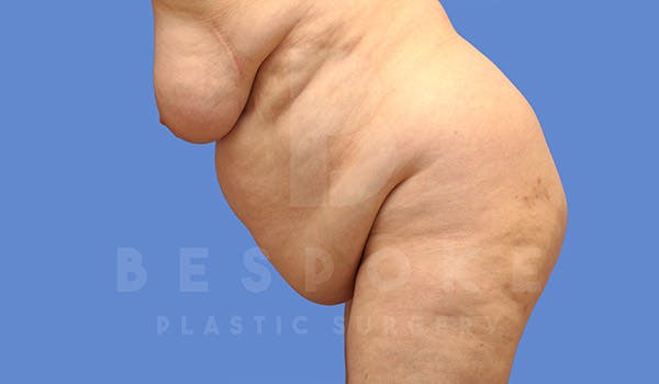 Tummy Tuck Before & After Gallery - Patient 4709957 - Image 5