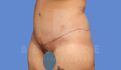 Tummy Tuck Before & After Gallery - Patient 4709958 - Image 4