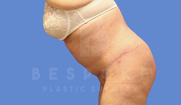 Tummy Tuck Before & After Gallery - Patient 4709957 - Image 6