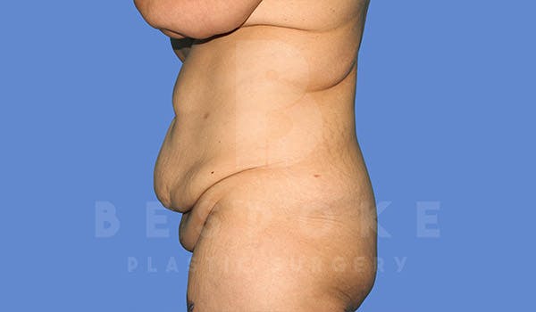 Tummy Tuck Before & After Gallery - Patient 4709958 - Image 5