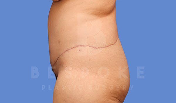 Tummy Tuck Gallery - Patient 4709958 - Image 6