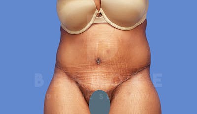 Tummy Tuck Before & After Gallery - Patient 4709960 - Image 2