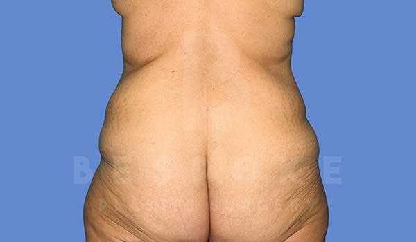 Tummy Tuck Before & After Gallery - Patient 4709958 - Image 7