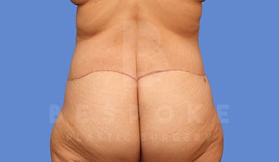 Tummy Tuck Before & After Gallery - Patient 4709958 - Image 8