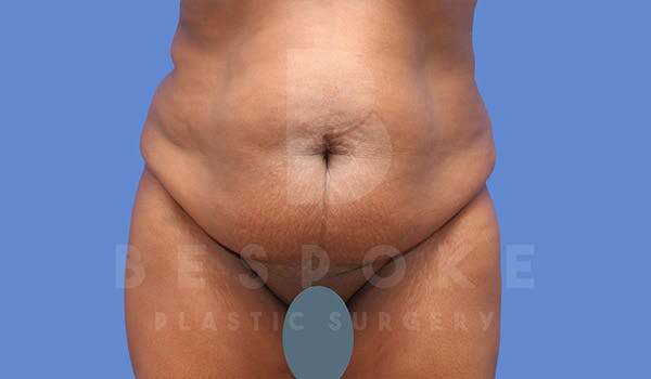 Tummy Tuck Before & After Gallery - Patient 4709961 - Image 1