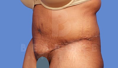 Tummy Tuck Before & After Gallery - Patient 4709960 - Image 4