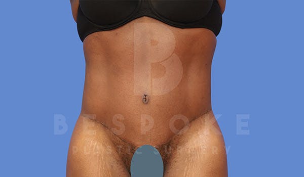 Tummy Tuck Before & After Gallery - Patient 4709961 - Image 2