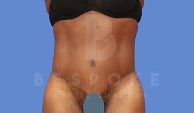 Tummy Tuck Gallery - Patient 4709961 - Image 2
