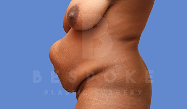 Tummy Tuck Before & After Gallery - Patient 4709960 - Image 5