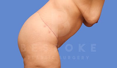 Tummy Tuck Before & After Gallery - Patient 4709958 - Image 10