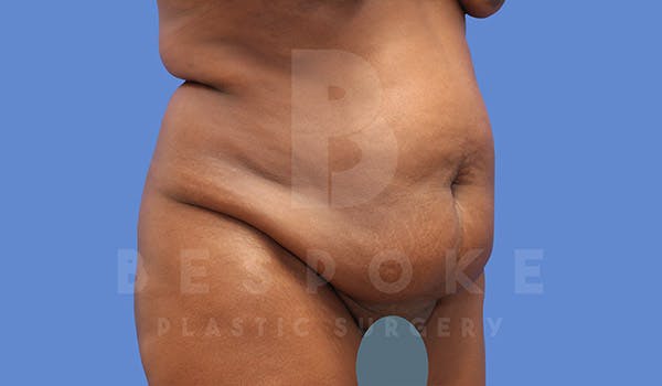Tummy Tuck Before & After Gallery - Patient 4709961 - Image 3