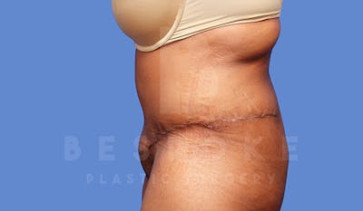 Tummy Tuck Before & After Gallery - Patient 4709960 - Image 6