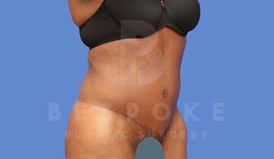 Tummy Tuck Before & After Gallery - Patient 4709961 - Image 4
